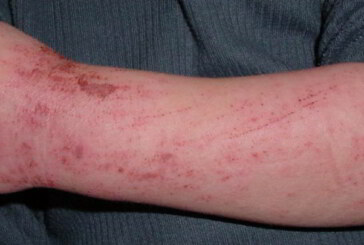 ATOPIJSKI DERMATITIS – jedna od najzastupljenijih kožnih bolesti na svetu